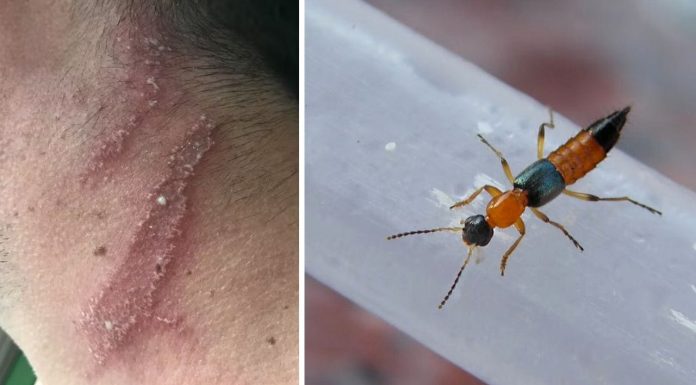 नाइरोबी फ्लाईको सम्पर्कले गराउन सक्छ छालामा संक्रमण