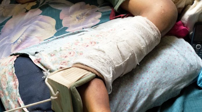 आक्रमणका दिन सिन्धुली अस्पतालबाट डिस्चार्ज गरिएका १३ बर्षिय बालक मंगलवहादुरको रकम अभावमा भएन गोडाको अपरेशन !