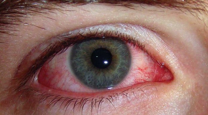 आँखा पाक्ने रोगले दियो सास्ती