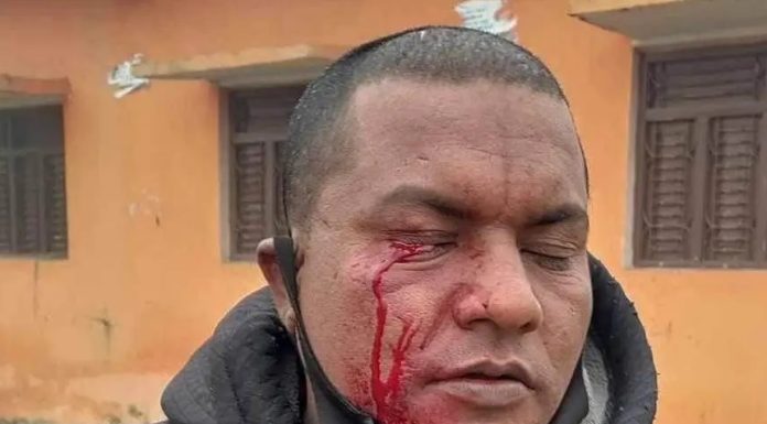 समाचार लेखेकै आधारमा रौतहटमा पत्रकारमाथि निर्मम आक्रमण, आँखामा गम्भीर चोट